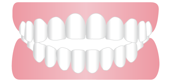 開咬・オープンバイト