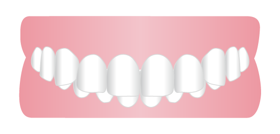 噛み合わせが深い
