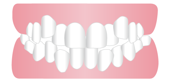 乱杭歯（叢生）