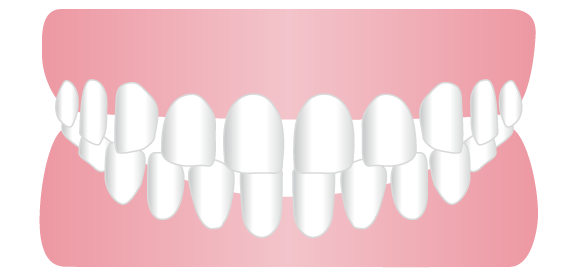 すきっ歯（空隙歯列）